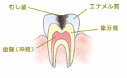 象牙質の虫歯（C2）