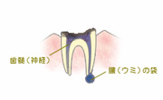 末期の虫歯（C4）