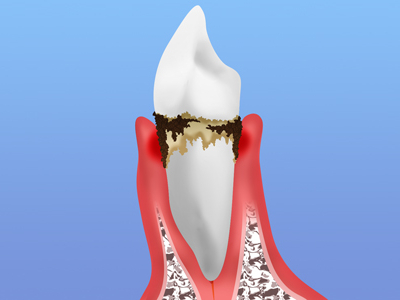 歯周病の検査と予防処置について
