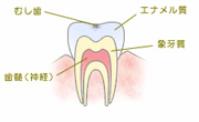 ごく初期の虫歯（C0）