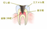 神経まで進行した虫歯（C3）