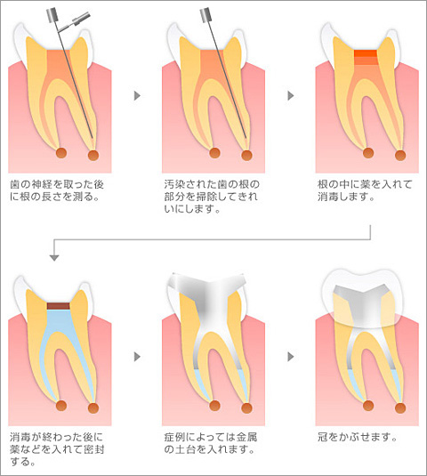 根管治療――できるだけ自分の歯を残すために